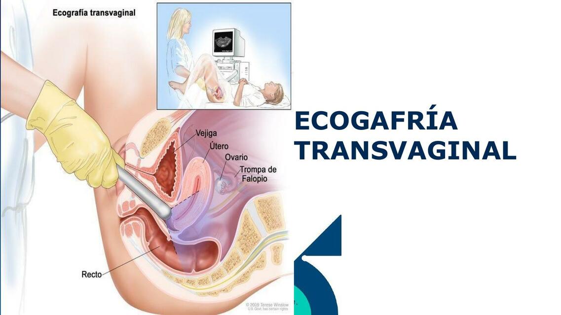 Ecografía transvaginal 