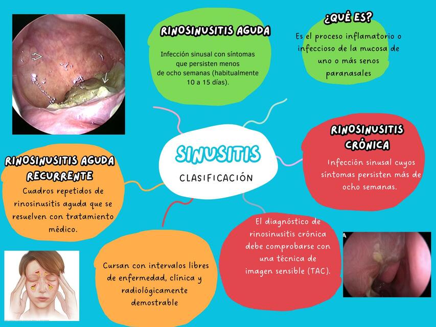 SINUSITIS AGUDA Y CRONICA