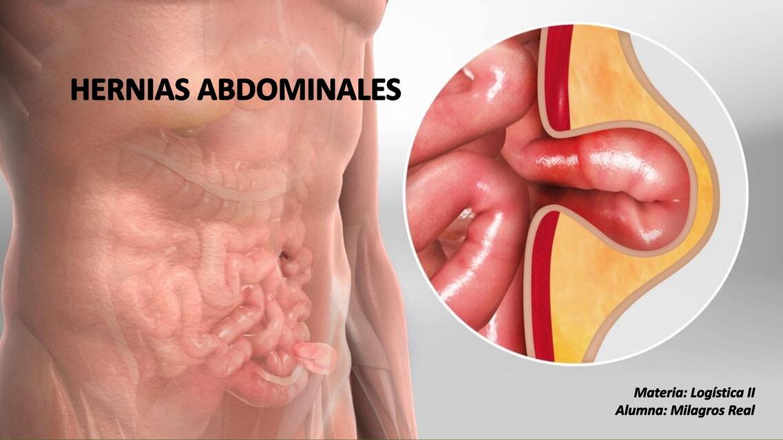 Hernias abdominales