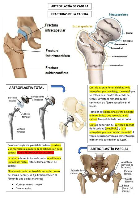 ARTROPLASTÍA DE CADERA