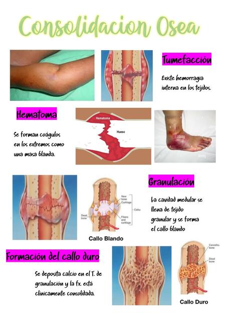 CONSOLIDACION OSEA