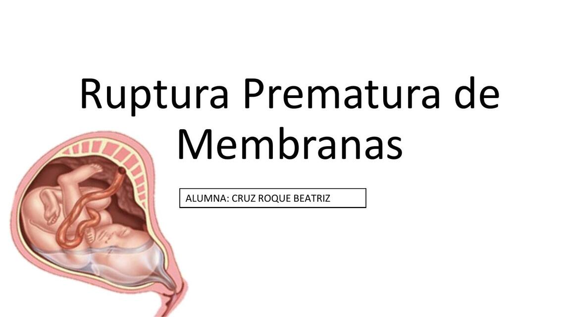 Ruptura prematura de membranas 