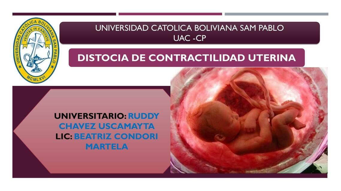 Distocia de contractilidad uterina 