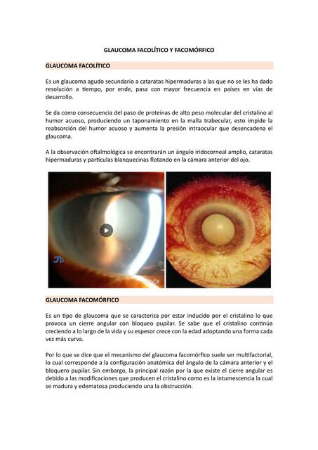 Glaucoma facomórfico y facolítico