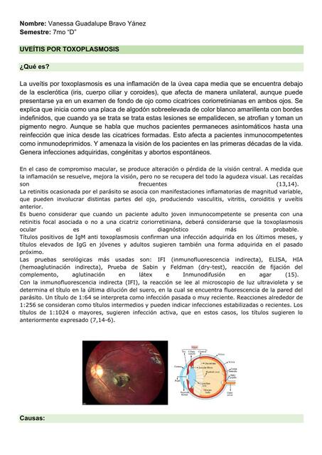 Uveitis por Toxoplasmosis