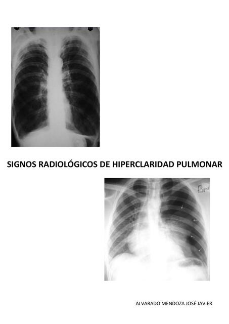 Hiperclaridad Pulmonar