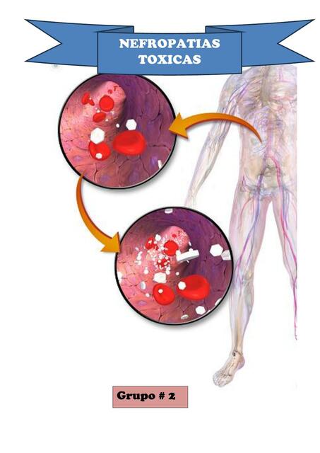 Grupo 2 NEFROPATIA TOXICA 1