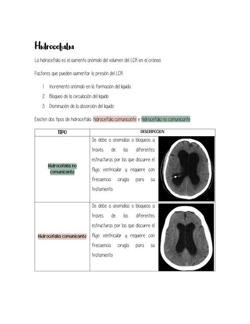 Hidrocefalia