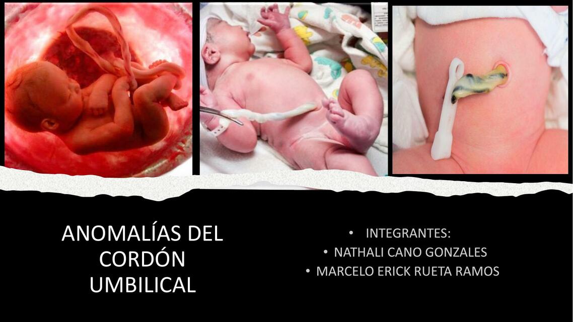 Anomalías del Cordón Umbilical