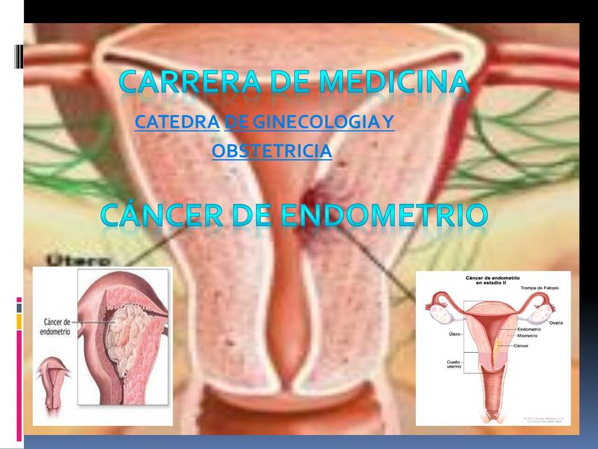 Cáncer de Endometrio 