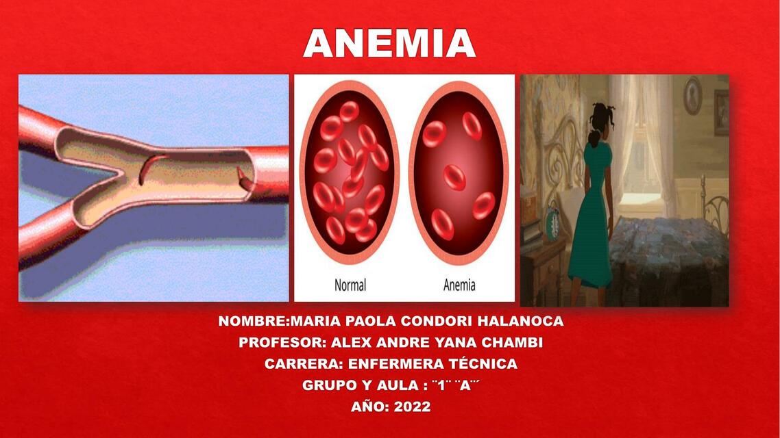 ANEMIA