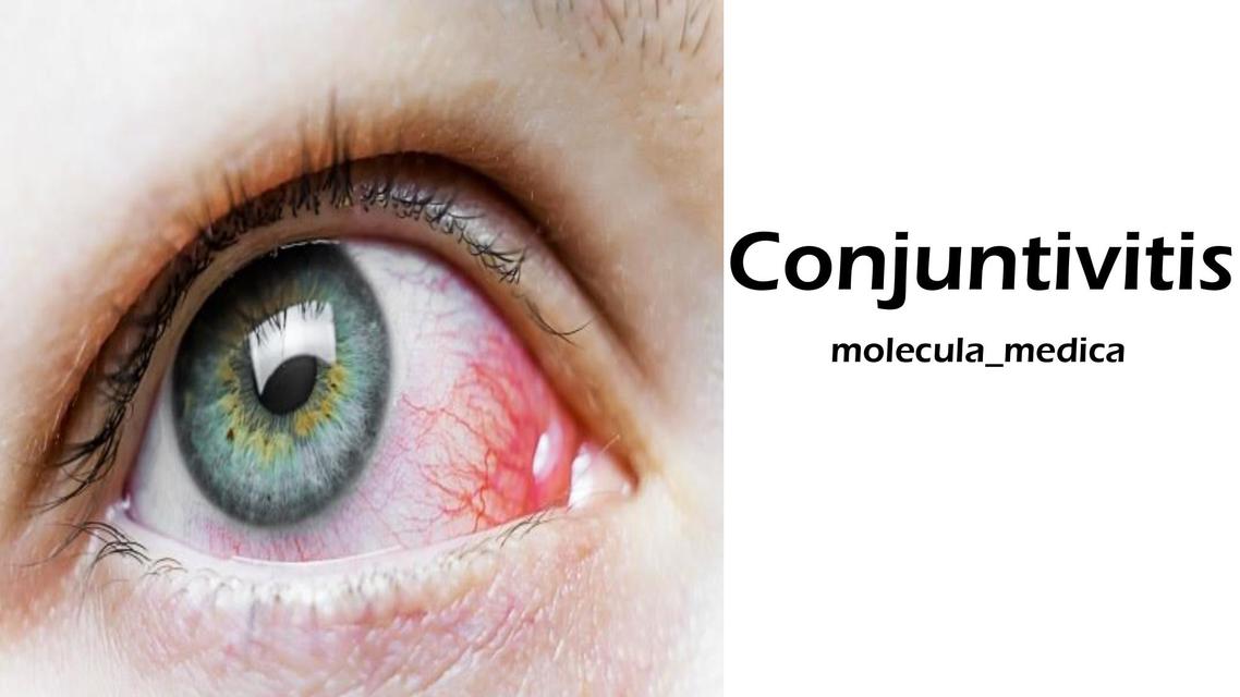 CONJUNTIVITIS