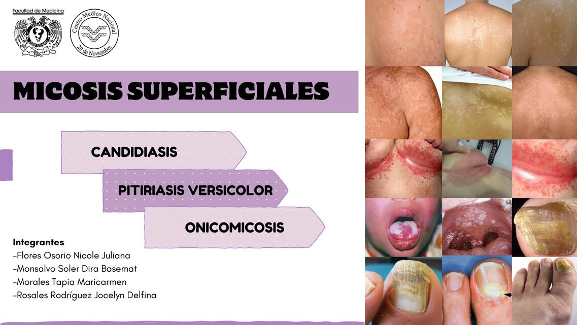 Micosis superficiales Candidiasis y Pitiriasis  