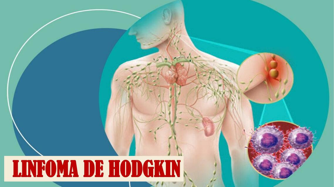 Linfoma de Hodgkin 