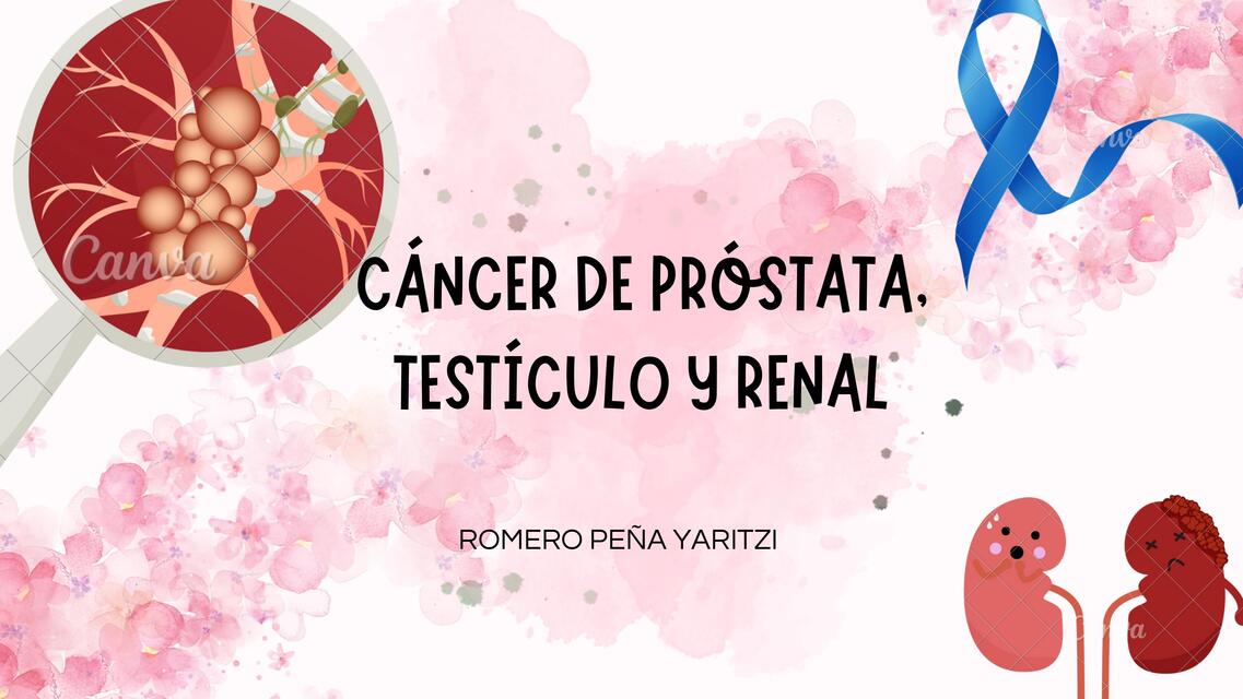 Cáncer de próstata: testículo y renal 