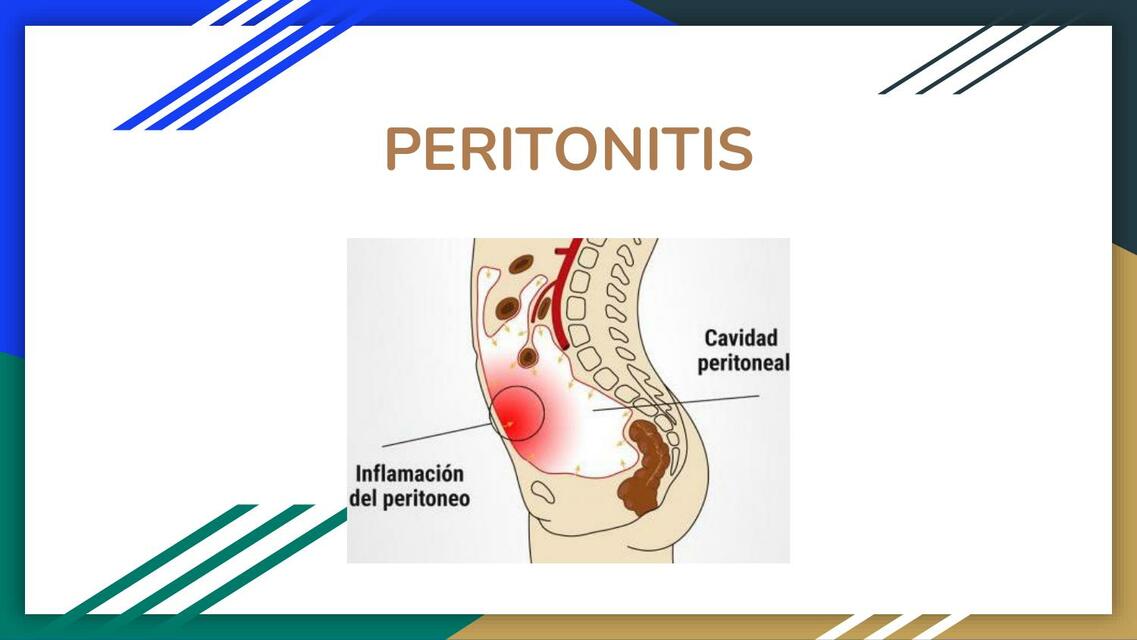 Peritonitis 