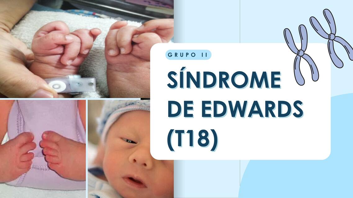 Síndrome de Edwars