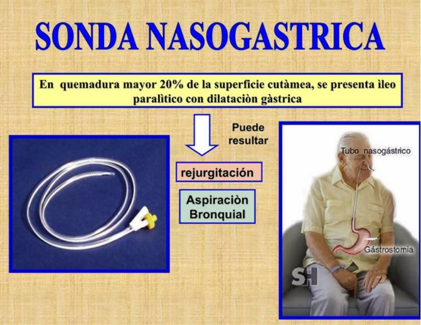 Quemaduras uso de sonda nasogastrica | Alxnsx s | uDocz