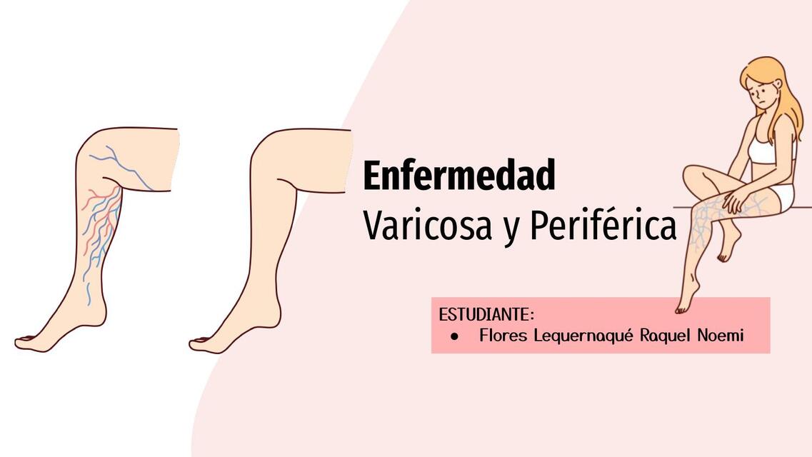 ENFERMEDAD VARICOSA Y PERÍFERICA