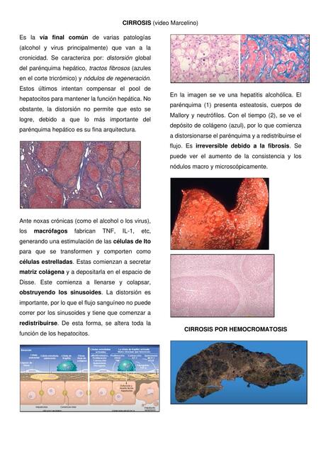 Cirrosis 