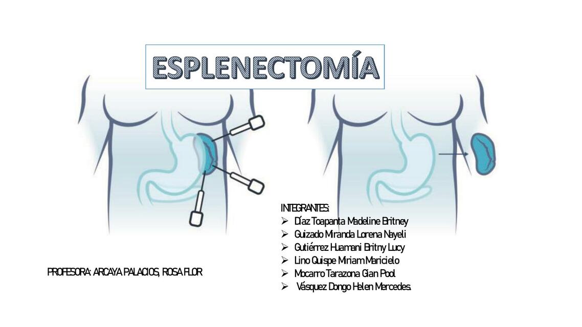 Esplenectomía