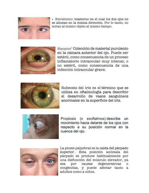 Signos oftalmológicos