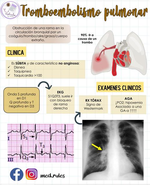 Tromboembolismo Pulmonar Busca Y Descarga Apuntes Gratis Udocz