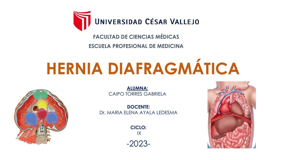 HERNIA DIAFRAGMÁTICA