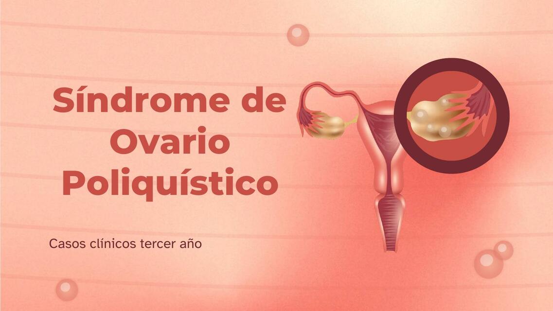 Sindrome de Ovario Poliquistico