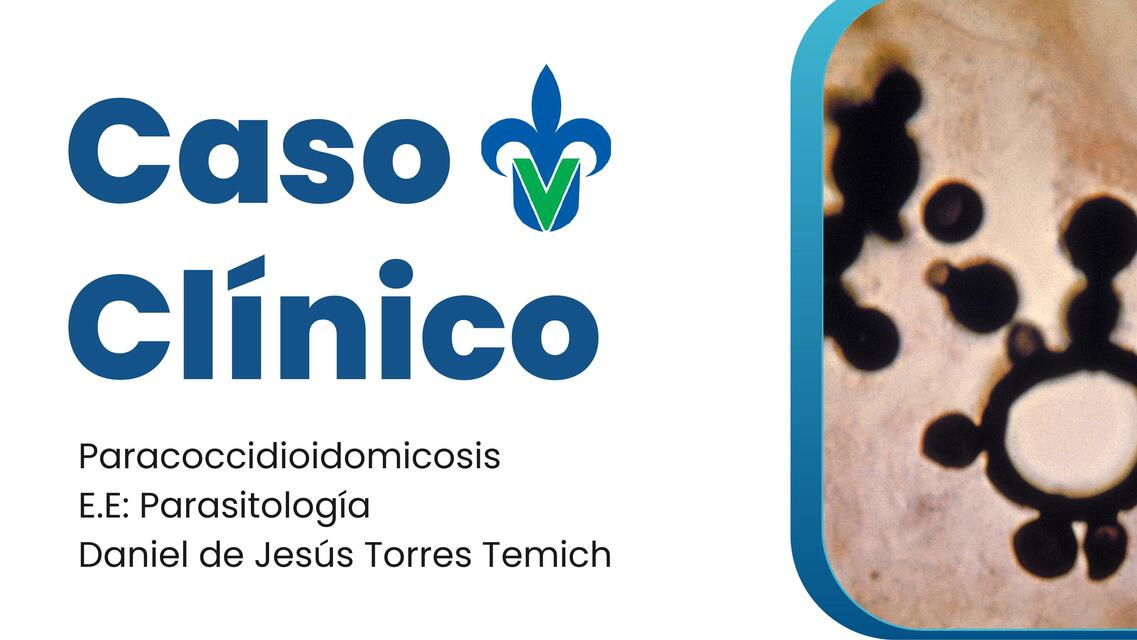 Paracoccidioidomicosis Caso clínico