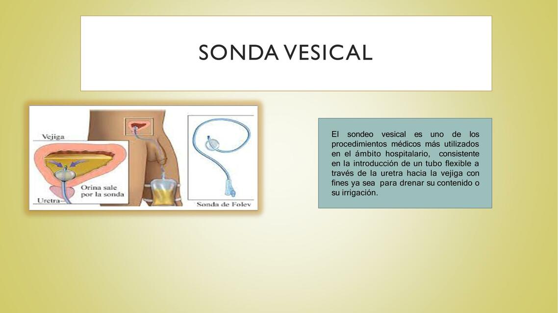 Sonda vesical 