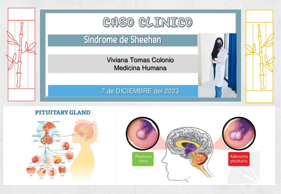 CASO CLINICO- Sindrome de SHEEHAN