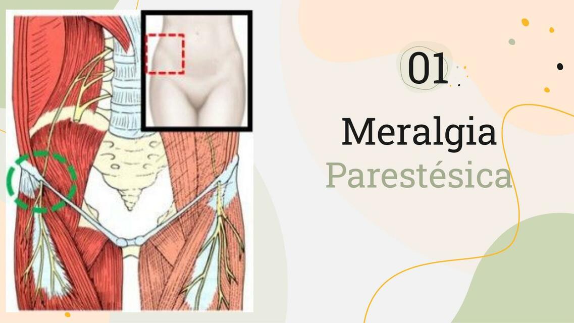 Meralgia Parestésica