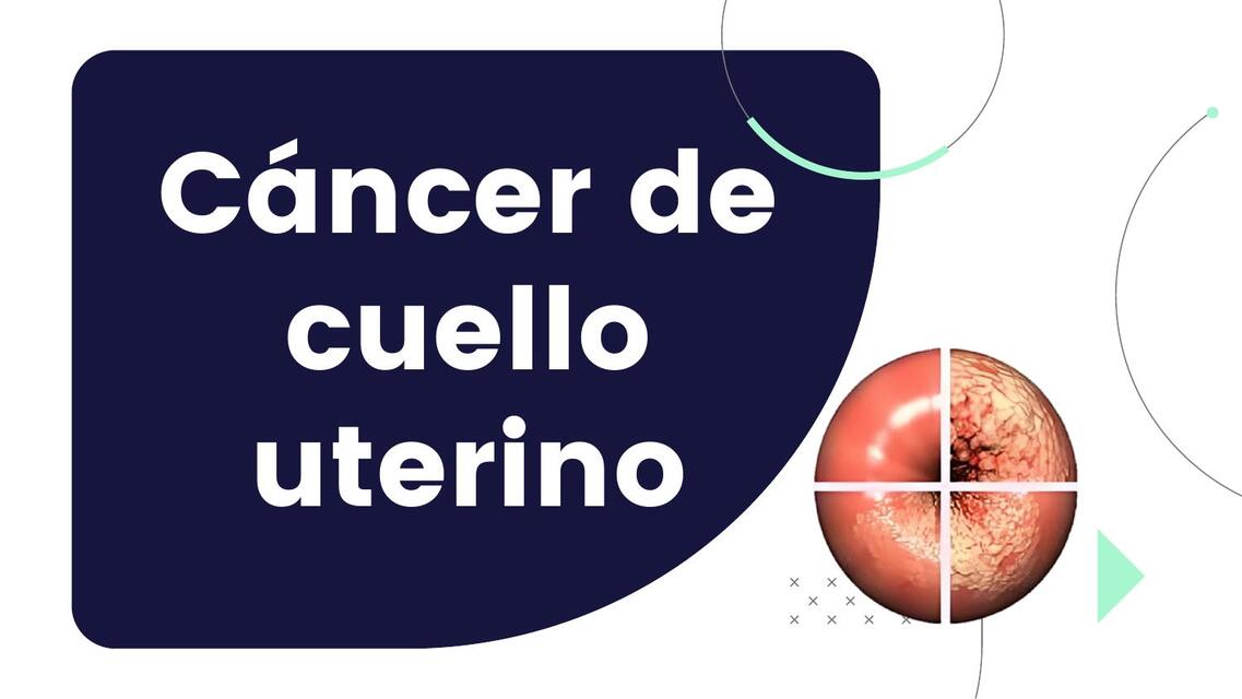 Cáncer de cuello uterino 