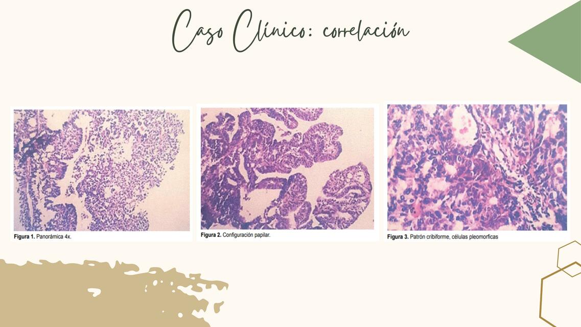 Cáncer endometrio Correlación 3