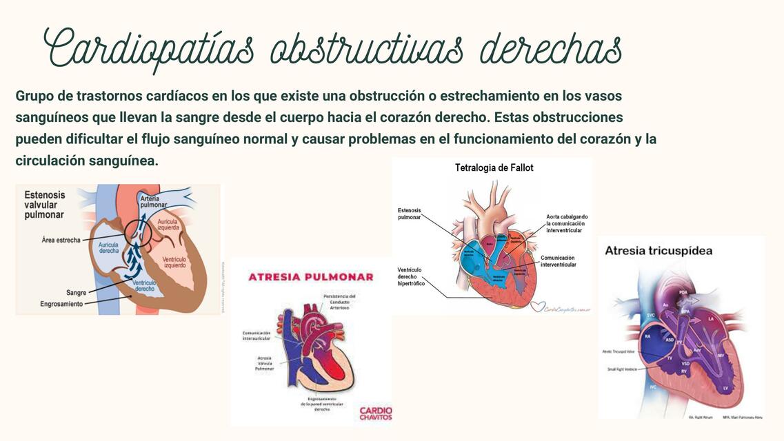 Cardiopatías obstructivas derechas