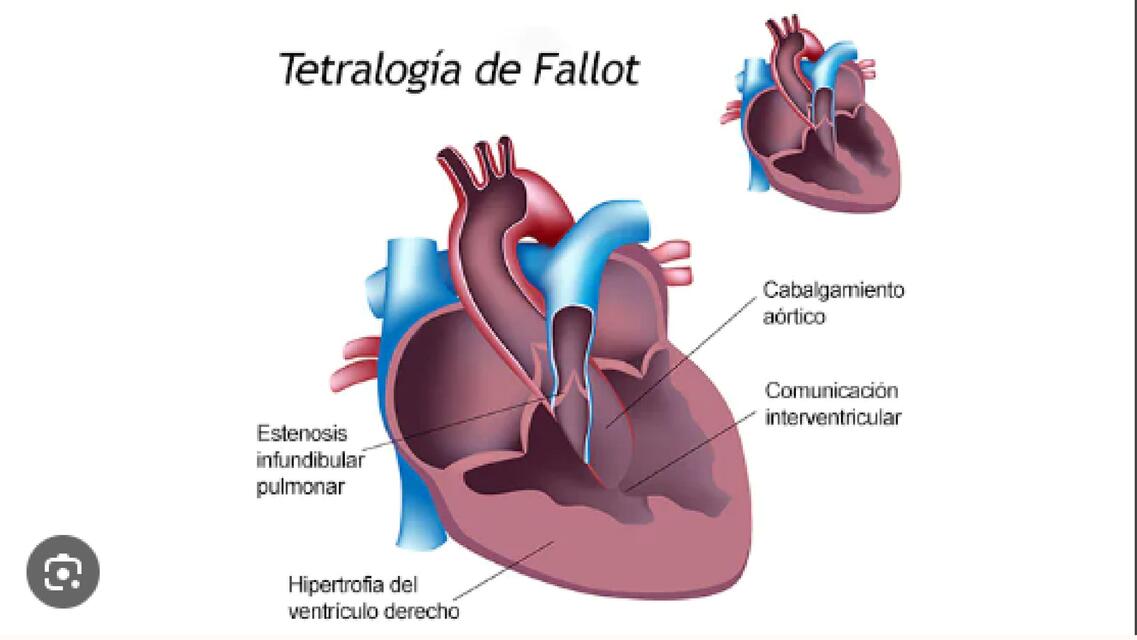 Tetralogía de Fallot