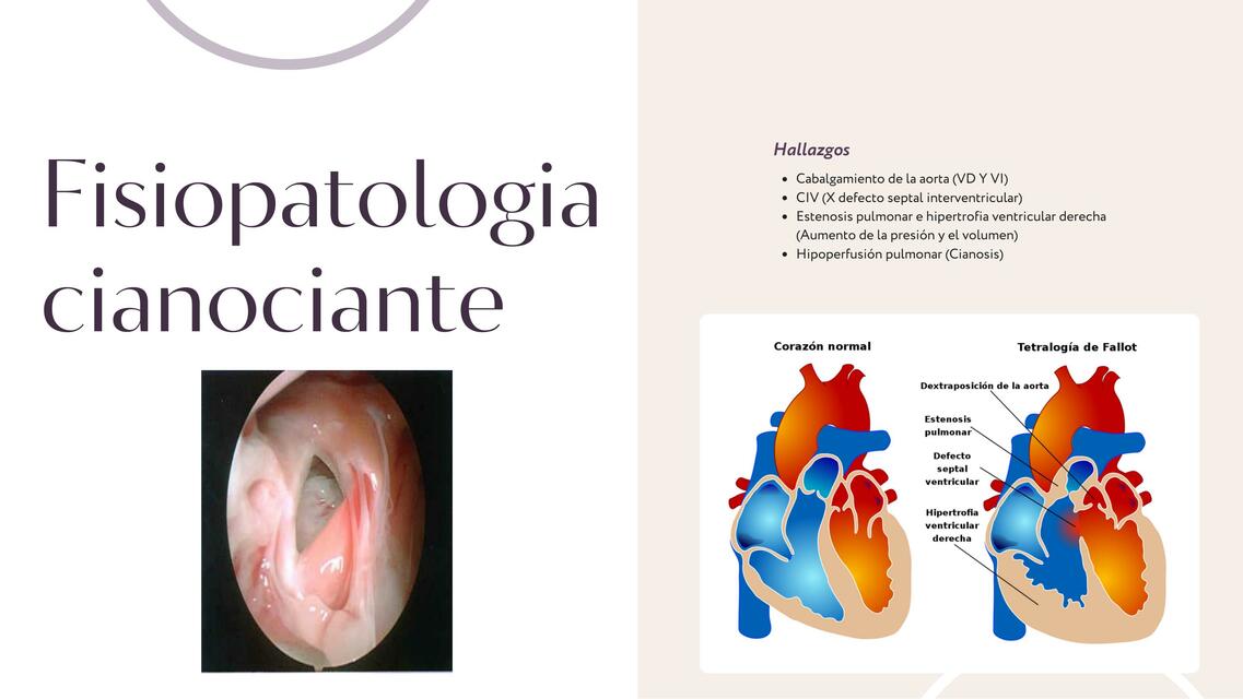 Tetralogía de Fallot 2