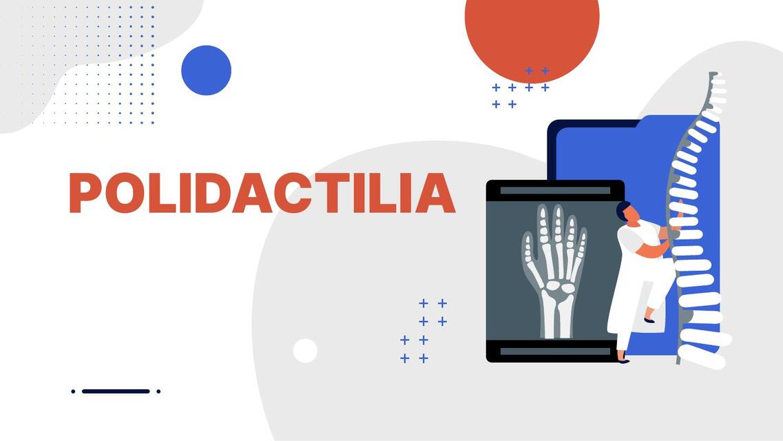 Polidactilia 