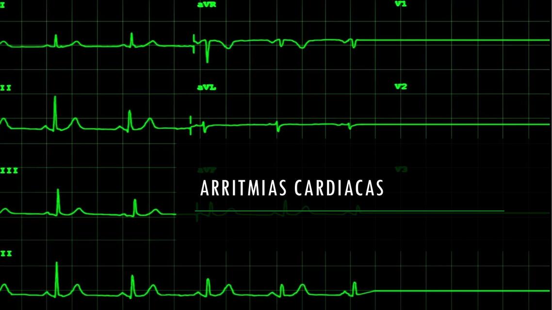 Arritmias Cardiacas Erica Af Udocz Arritmias Cardiacas Erica Af Udocz