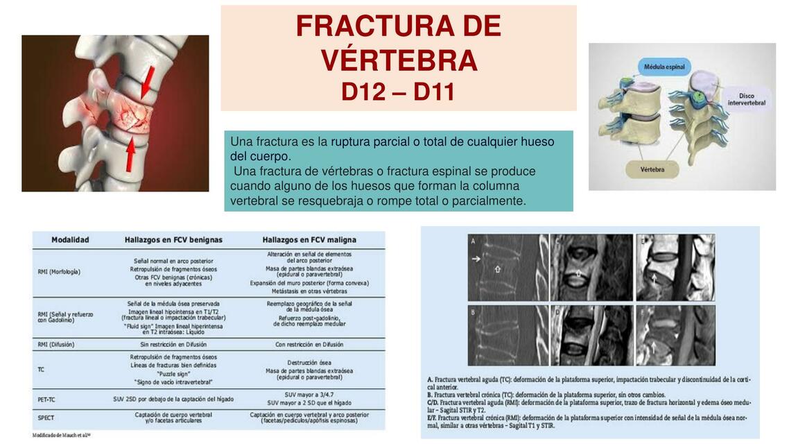 Fractura de Vértebra D12- D11