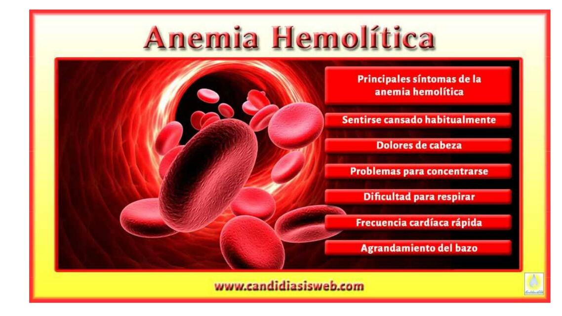 Anemia Hemolítica 