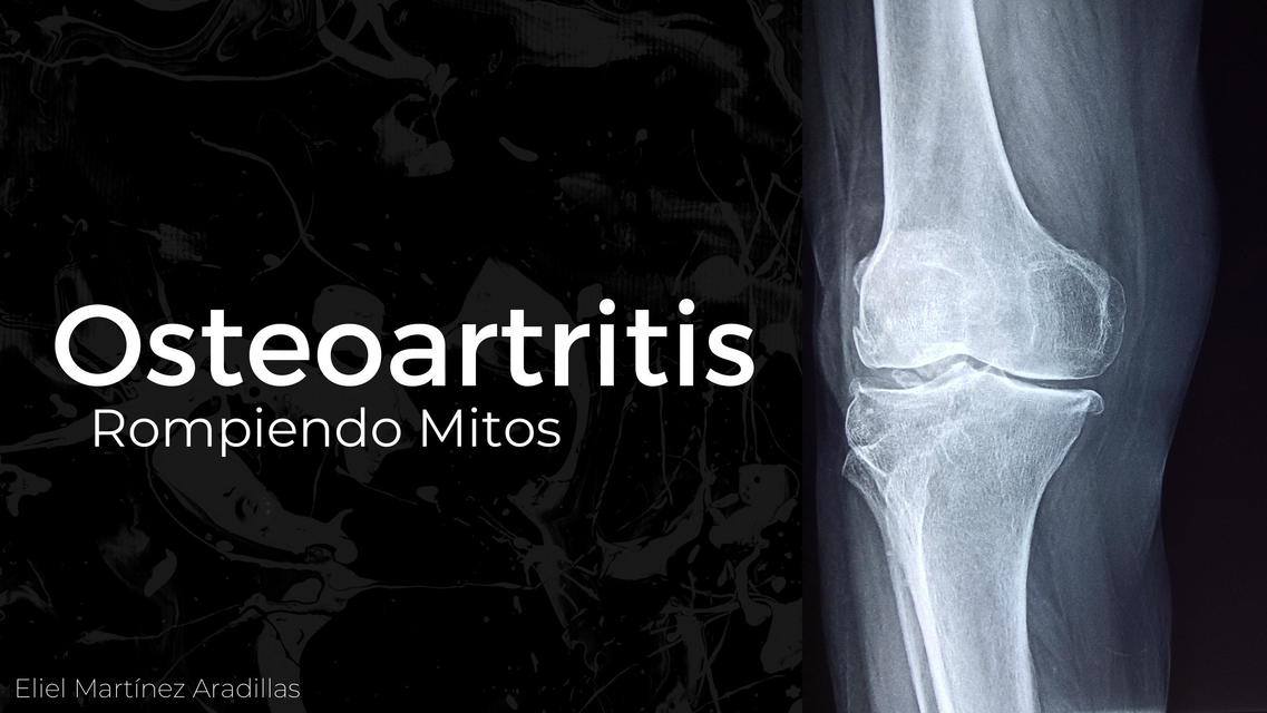 Osteoartritis - Rompiendo Mitos