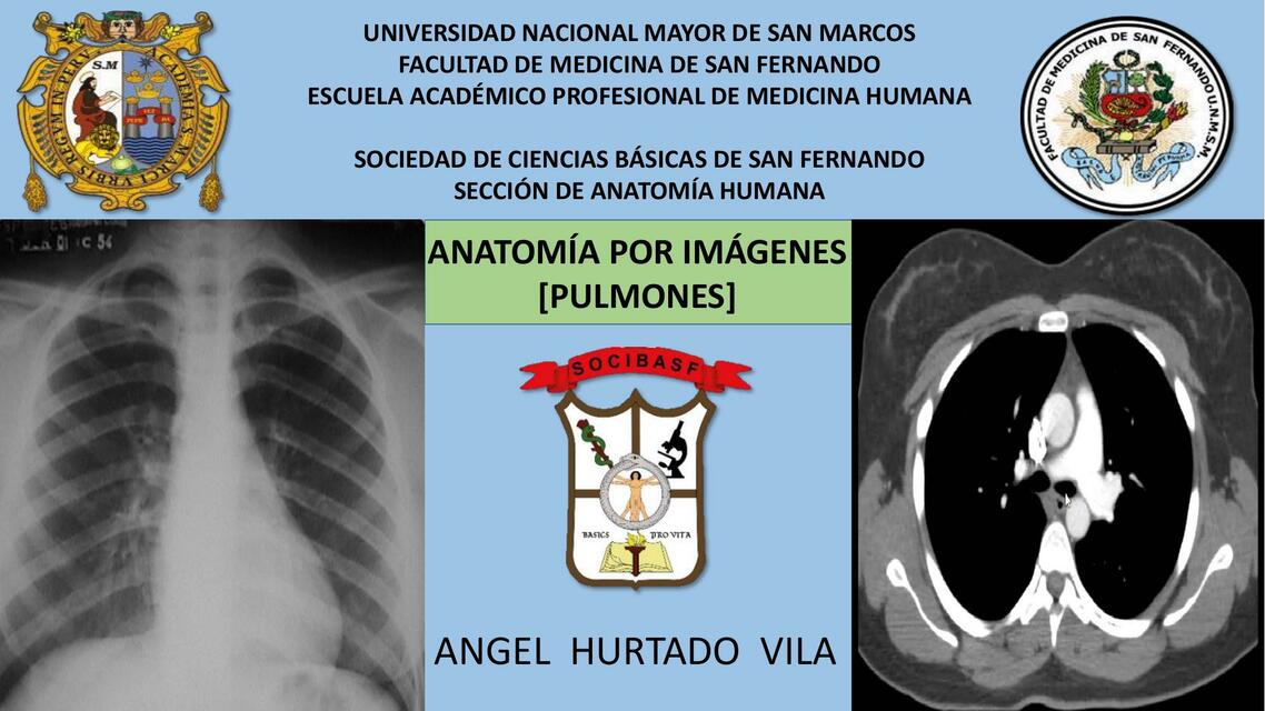 Anatomía por Imágenes- Pulmones 