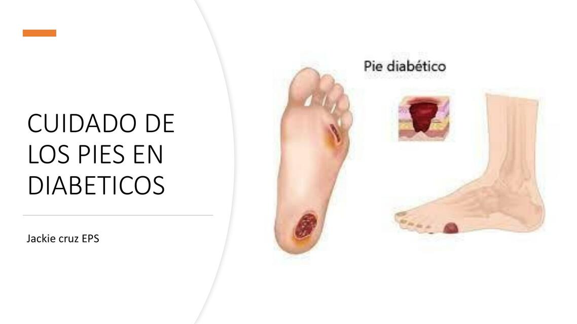 Cuidados para el pie diabético