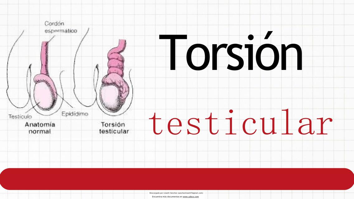 Torsión Testicular 