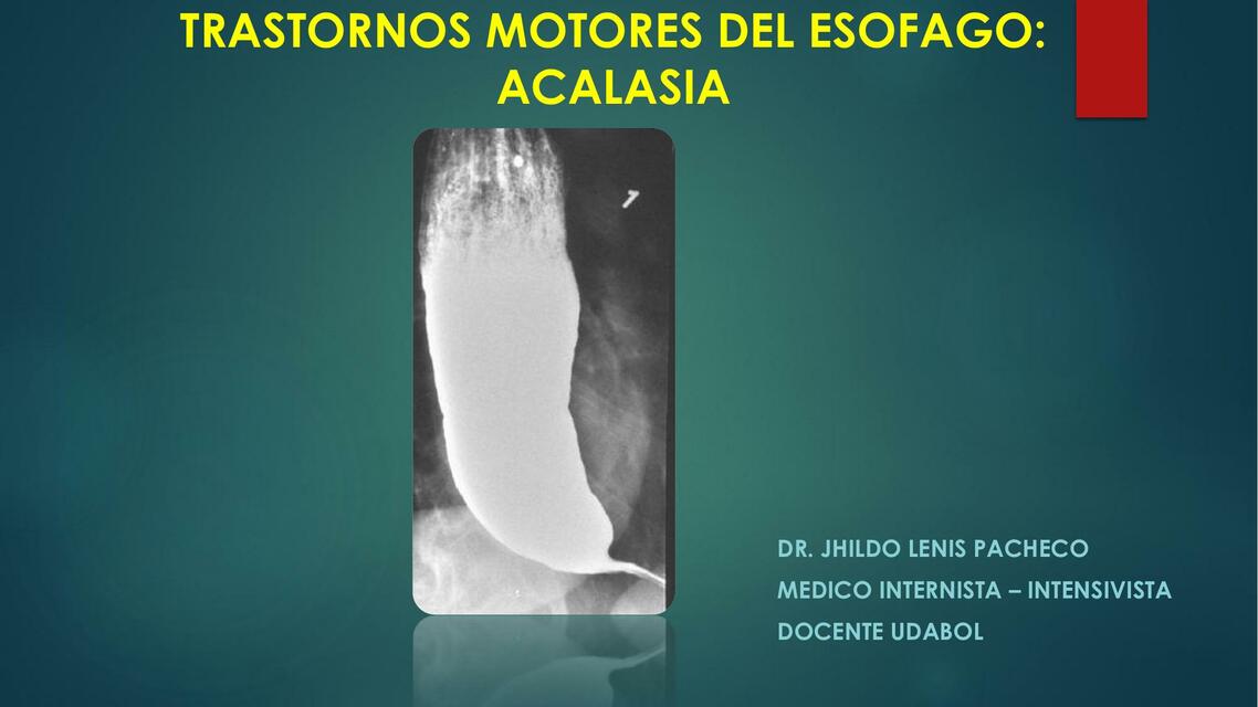 Trastornos motores del esófago: acalasia