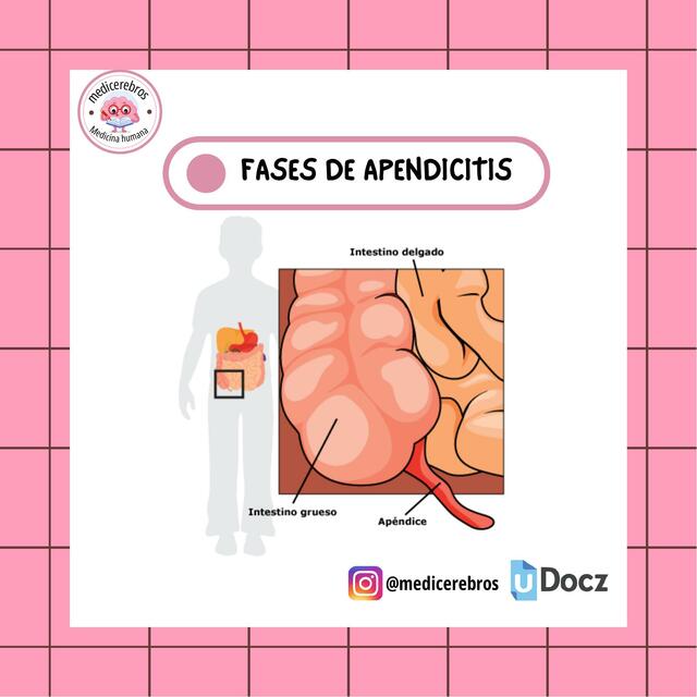 Fases de apendicitis aguda