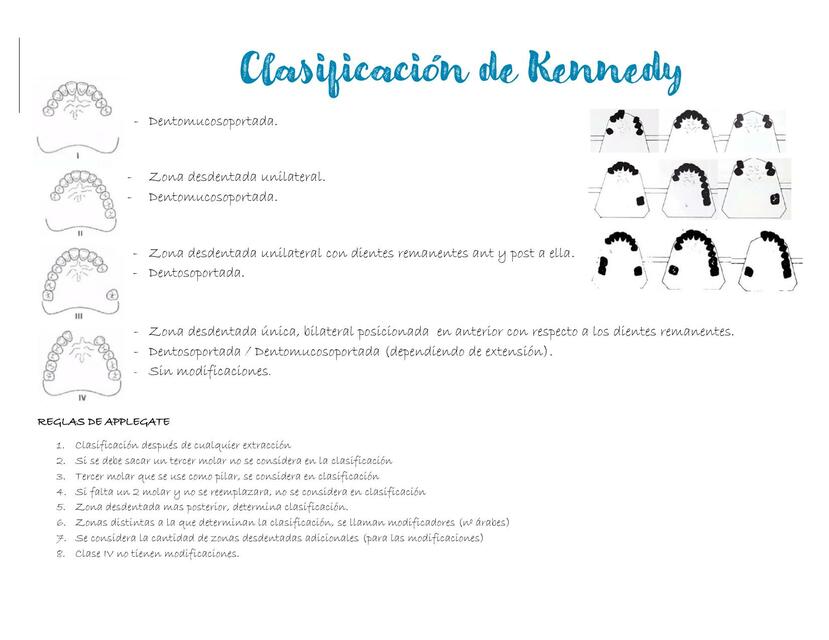 Clasificación de Kennedy 