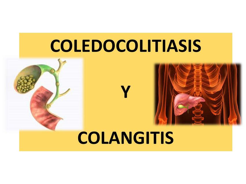 Coledocolitiasis y colangitis